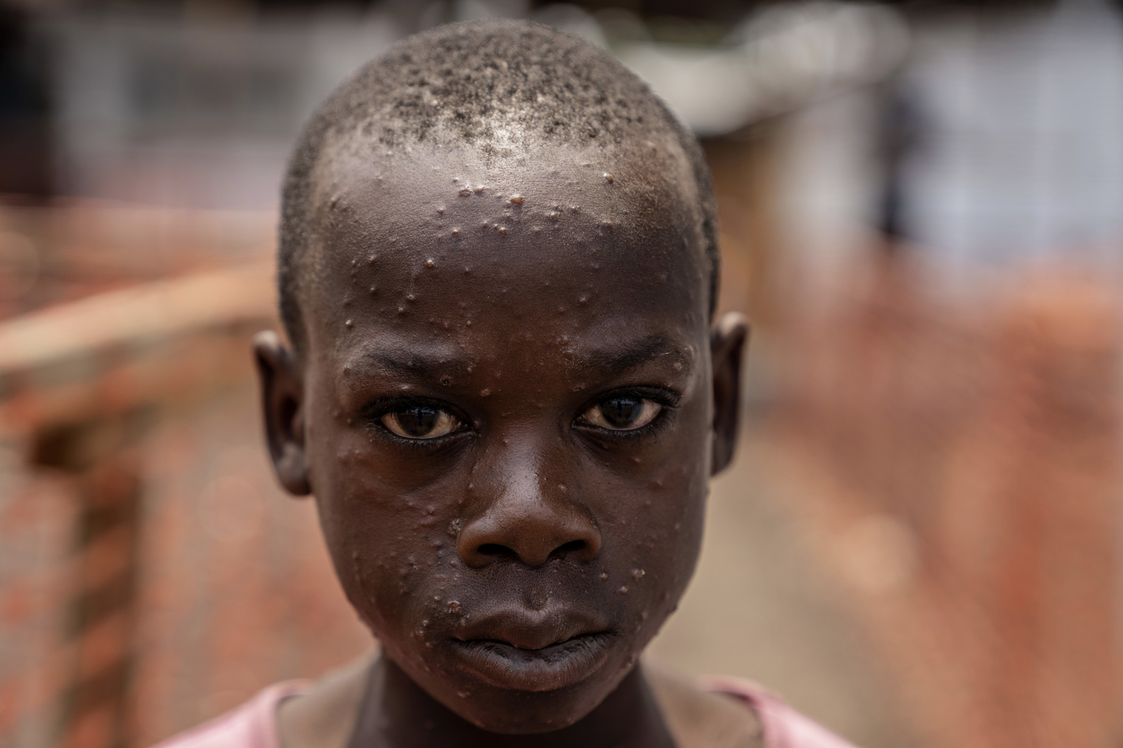 What does the US withdrawal from the WHO mean for global health?