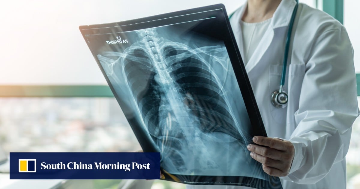 Malaysia risks under-reporting of TB cases as ‘slow-burn epidemic’ persists