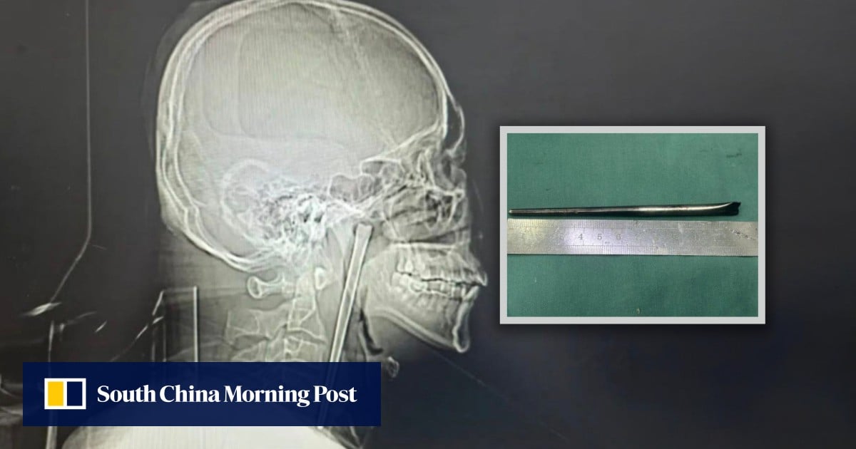 Chinese man lives for 8 years with chopstick stuck in throat, resisting surgery due to fear