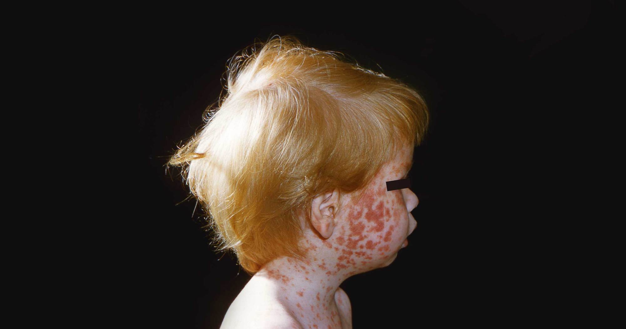 How Robert F. Kennedy Jr.’s Vaccine Agenda Risks a Resurgence of Deadly Childhood Plagues