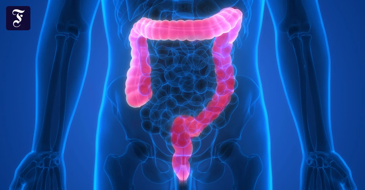 Millionen Betroffene: So hilft richtige Ernährung gegen Reizdarm