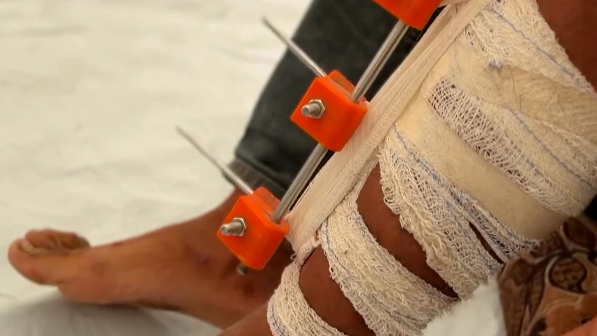 Gaza doctors create 3D-printed devices to save patients from amputation