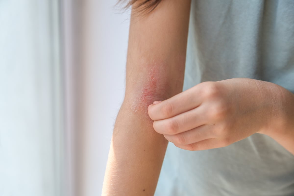 Dermatitis atópica y psoriasis: afectan a la piel, impactan en la mente