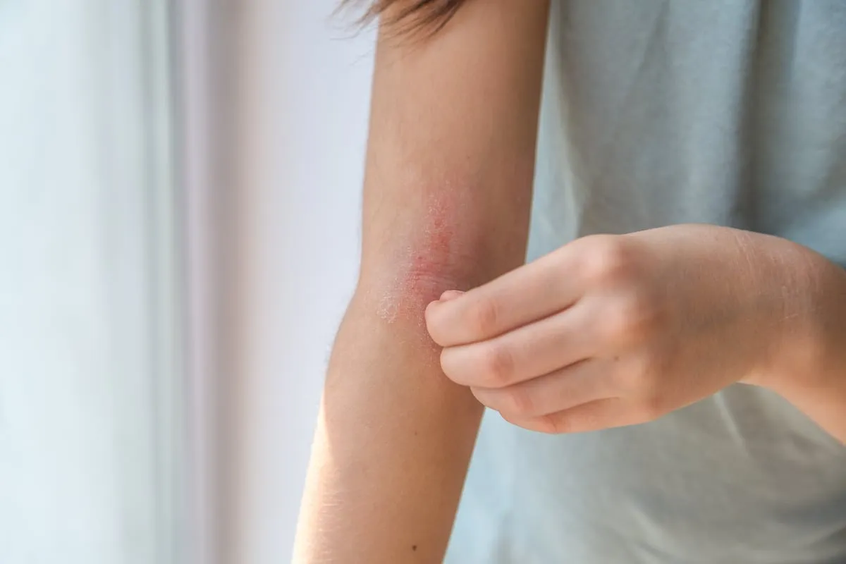 Dermatitis atópica y psoriasis: afectan a la piel, impactan en la mente
