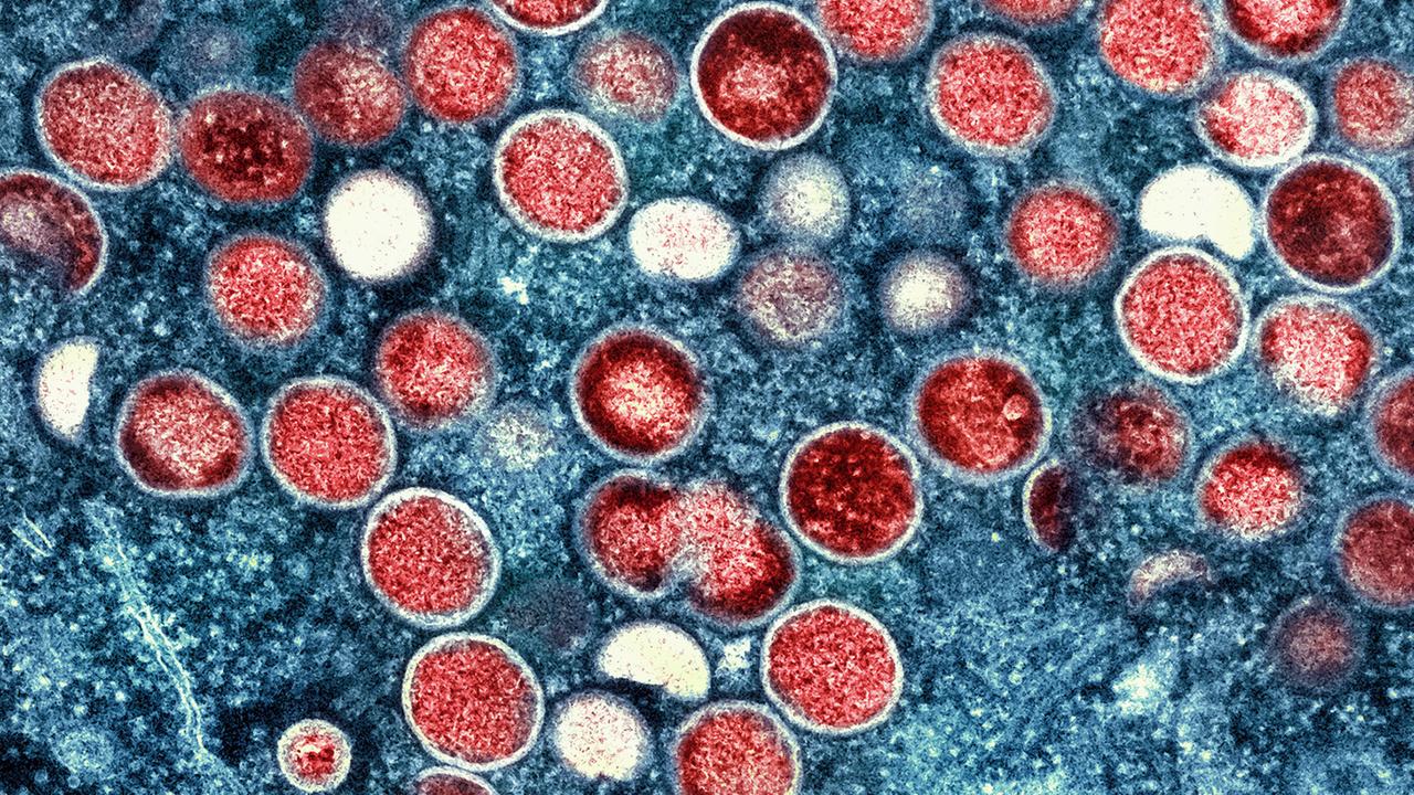 In Deutschland gibt es erste Fälle der MPox-Variante Klade Ib
