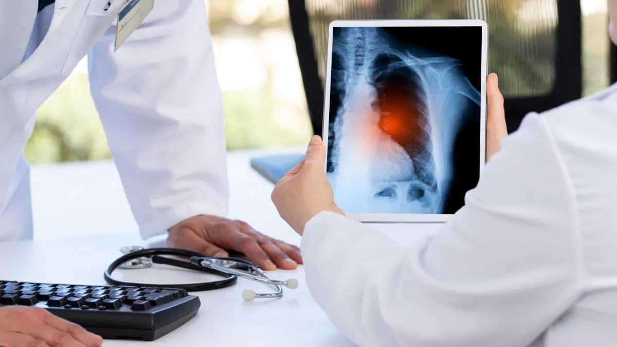 ¿De la biopsia al análisis de sangre para abordar el cáncer de pulmón?
