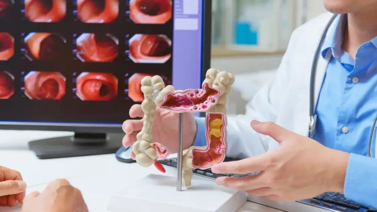 
         Los factores de riesgo del cáncer de colon, una enfermedad que cada vez afecta a más jóvenes 
    
