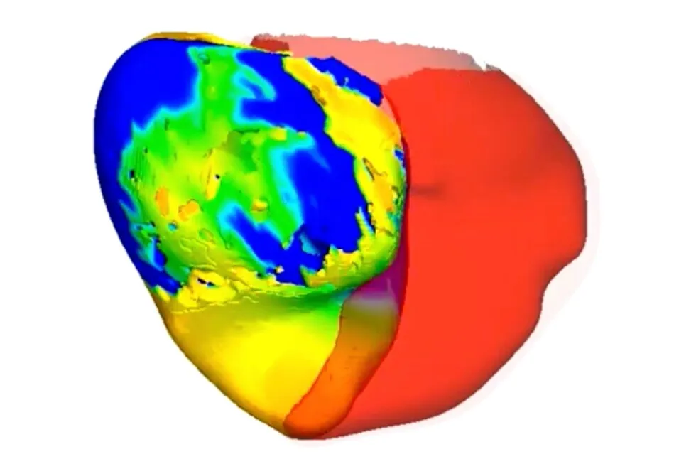 To fix a patient’s irregular heartbeat, doctors first tested its digital ‘twin’
