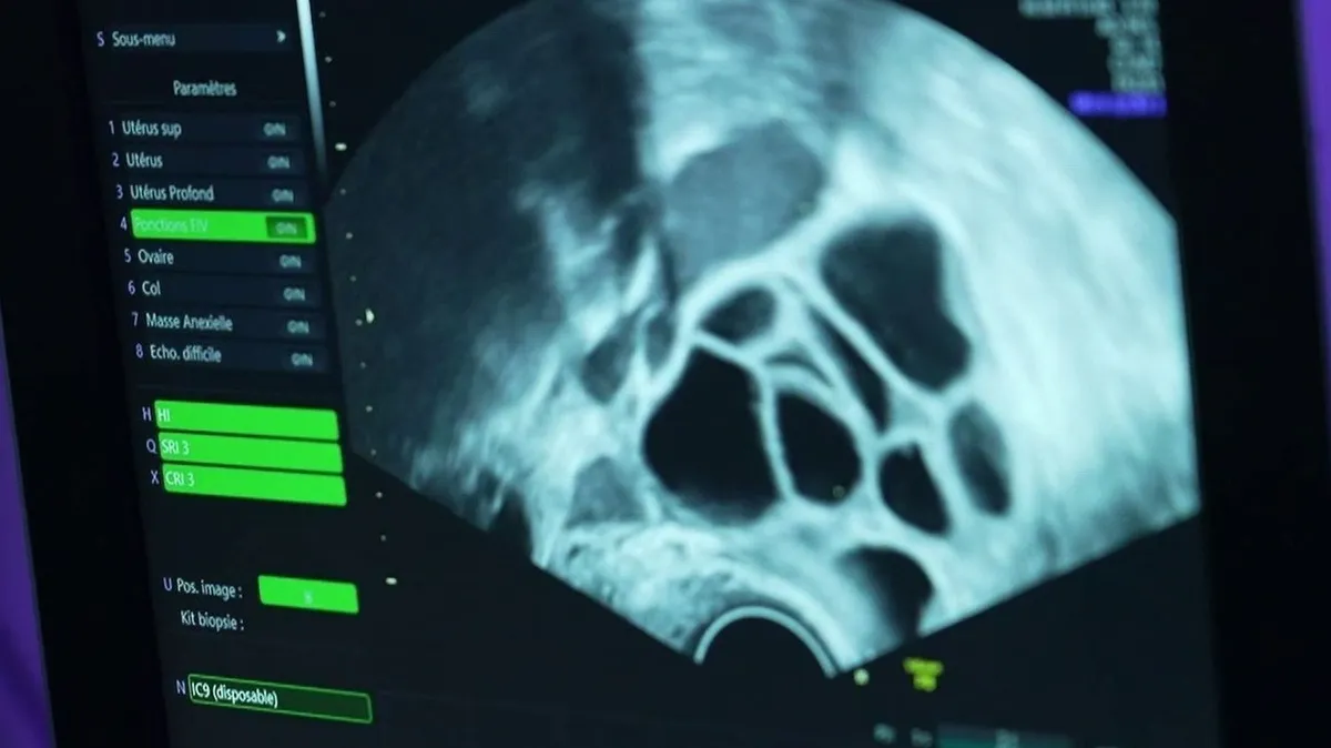"C'est le parcours du combattant" : les centre de congélation d'ovocytes débordés par les demandes