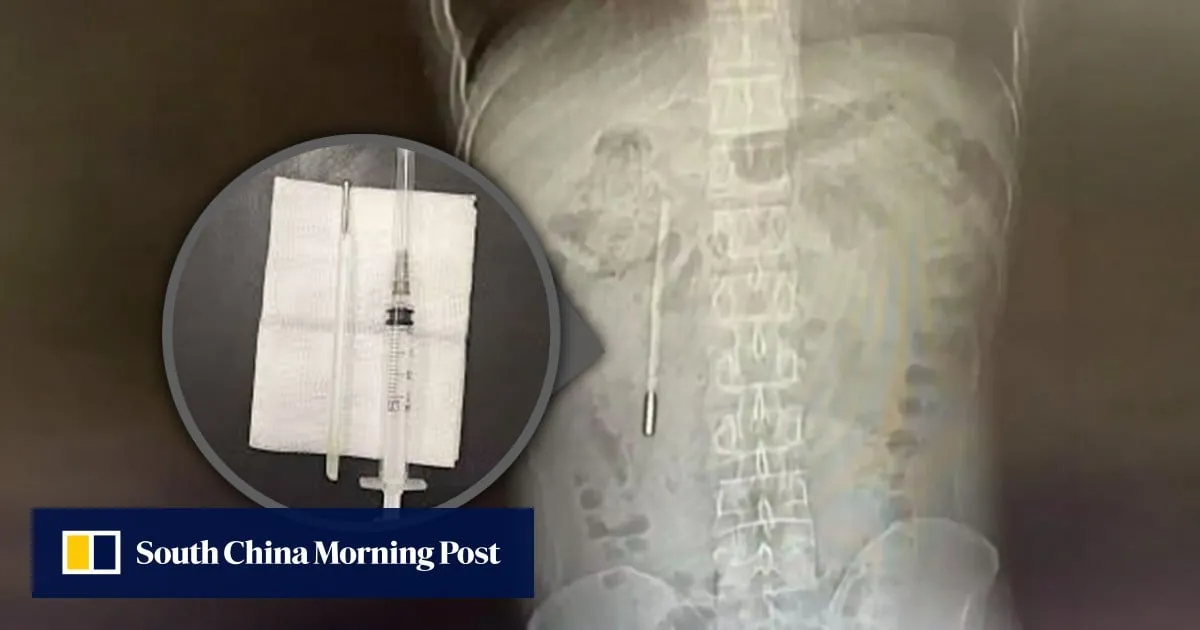 Chinese man, 32, suffers stomach pain, discovers thermometer swallowed as child still inside him