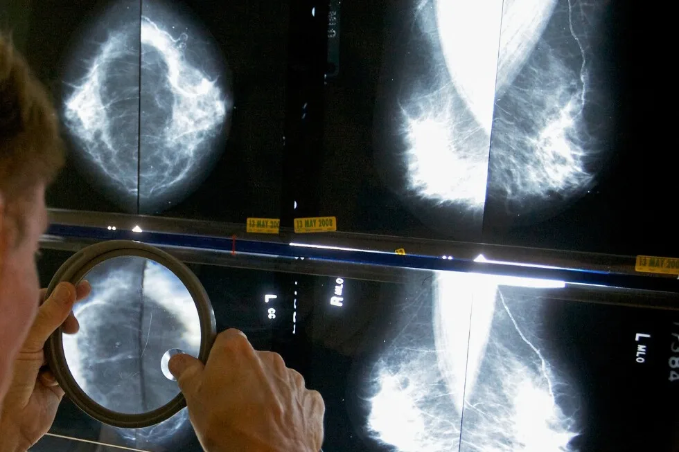 When should you get a mammogram? Conflicting advice makes it hard to know
