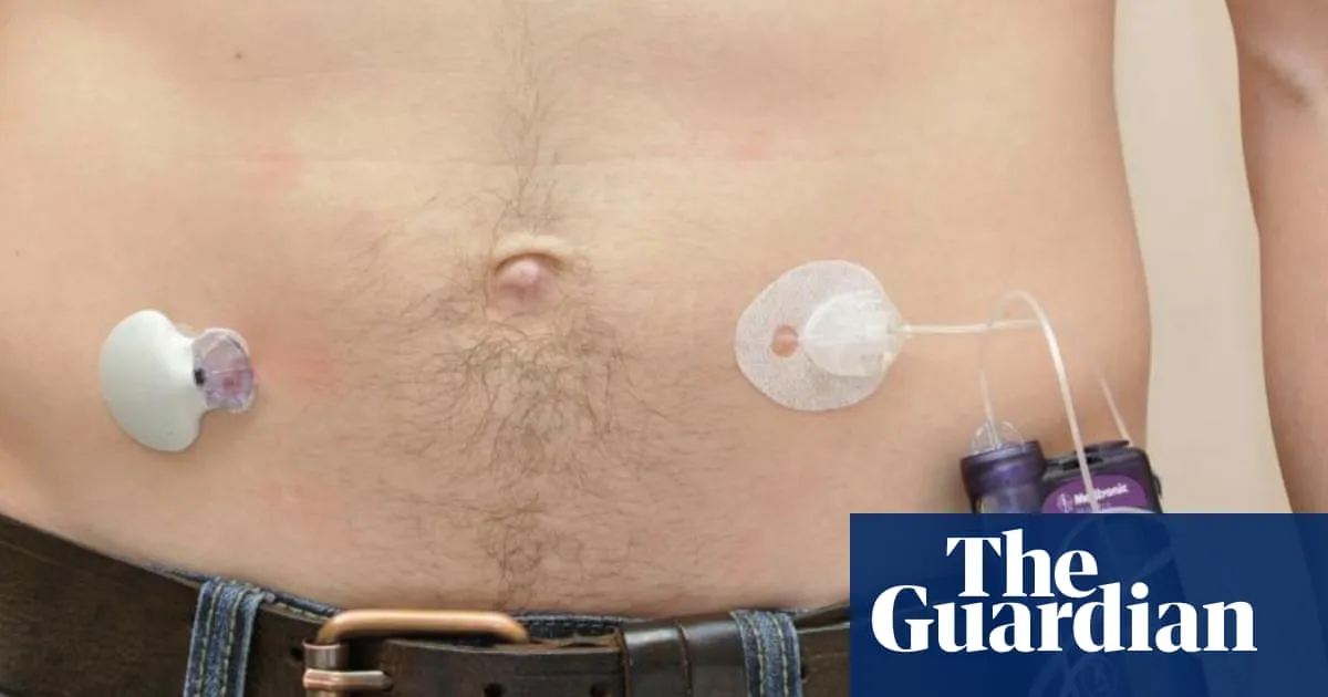 NHS rollout of artificial pancreas narrows inequality in diabetes care
