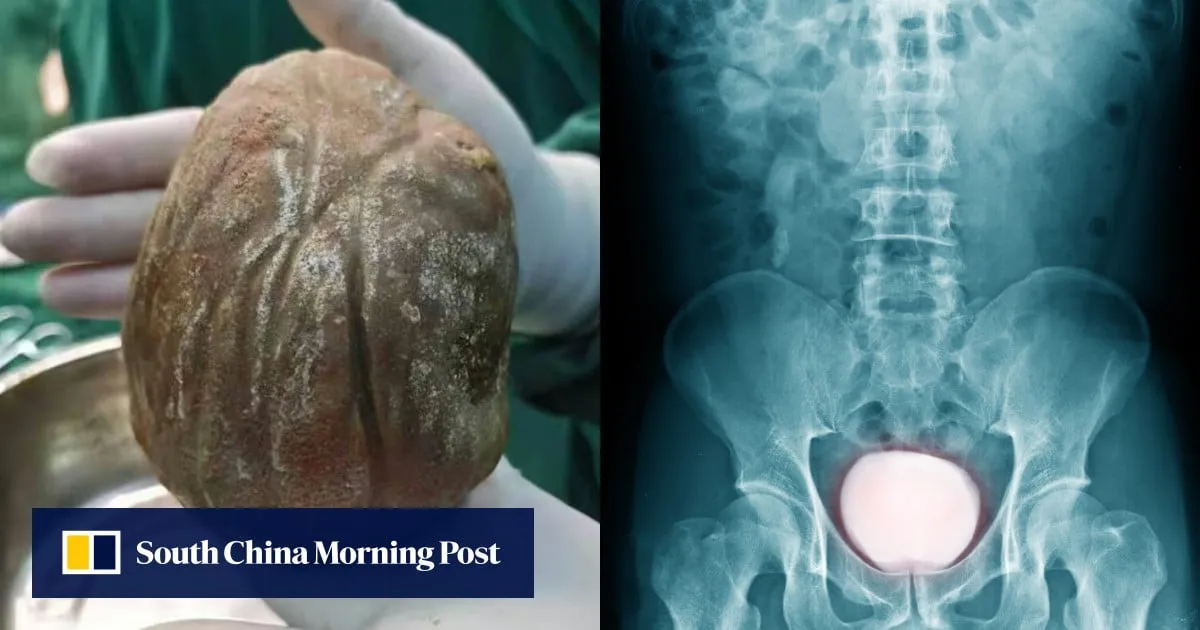 Chinese man who suffered painful urination for 3 years discovers 1.3kg stone in bladder