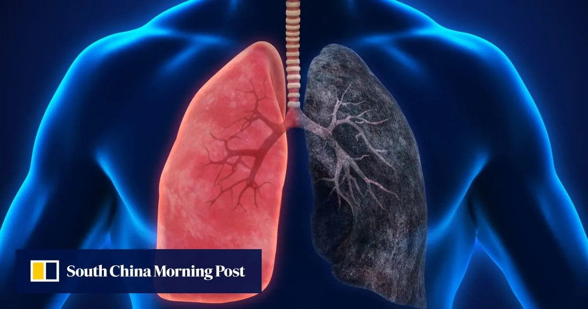 Akeso lung cancer drug shines in trials, boosting hopes in US$20b market