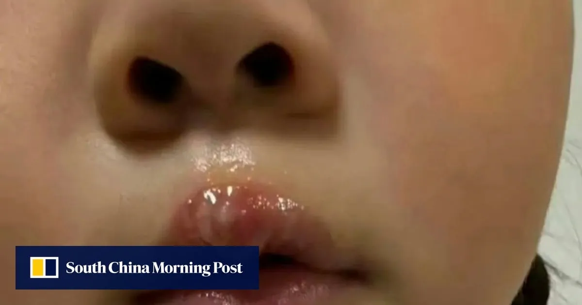 China teacher under probe after using glue gun to scald little girl, resulting in blisters