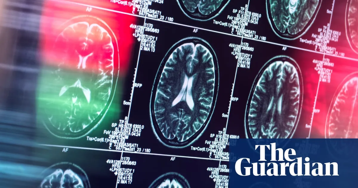 Antidepressants and antipsychotics could serve as alternatives to opioids, study finds