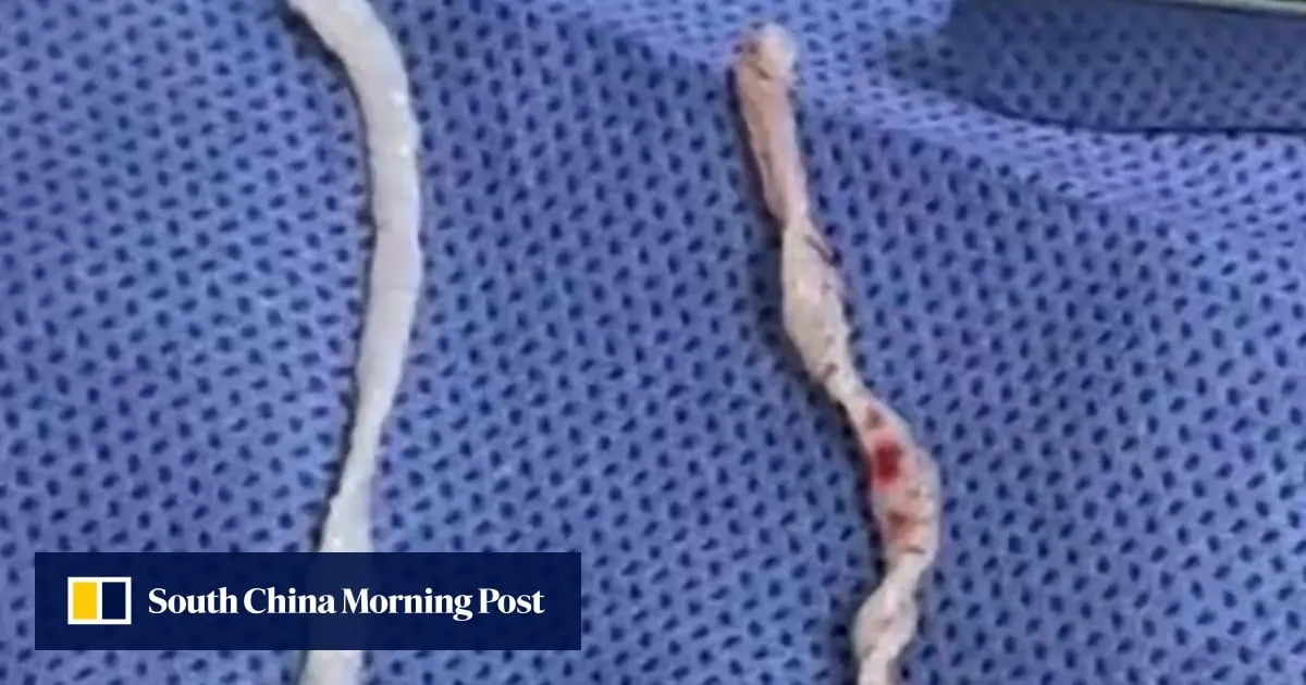 Chinese doctors remove pair of 10cm live worms from woman’s arm after year-long pain