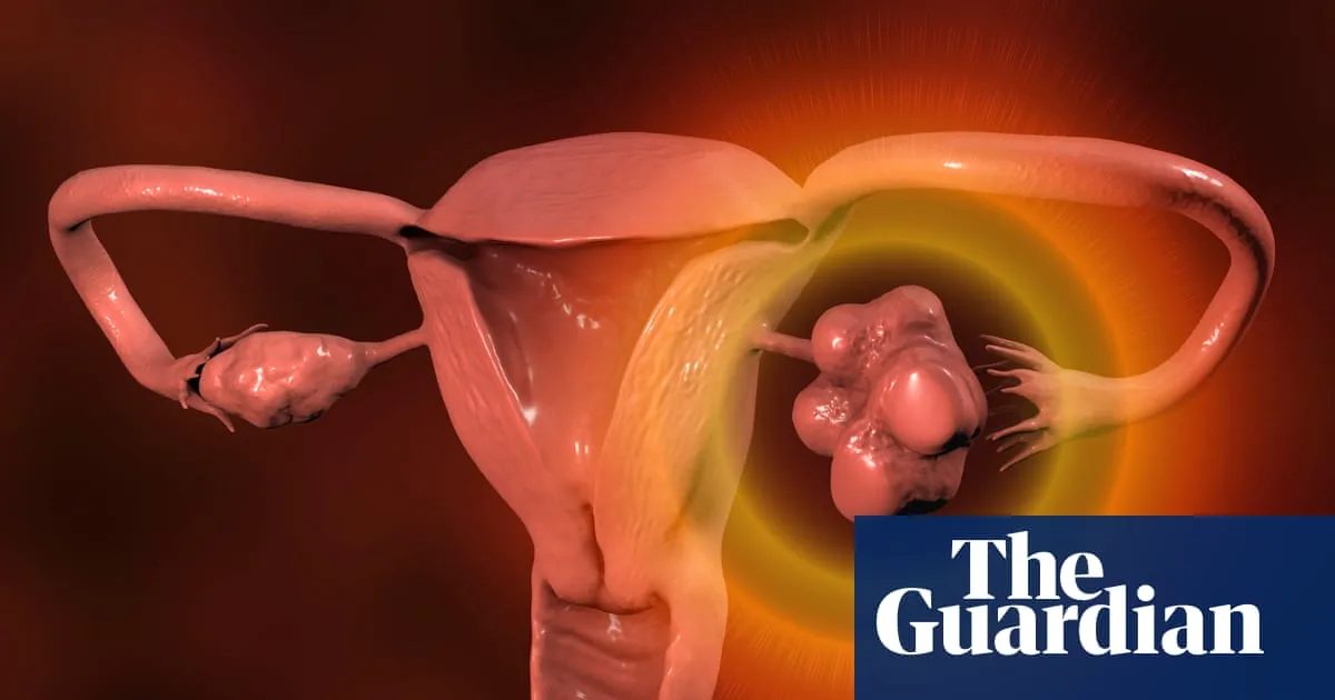 Women with irregular periods should be checked for PMOS, NHS says