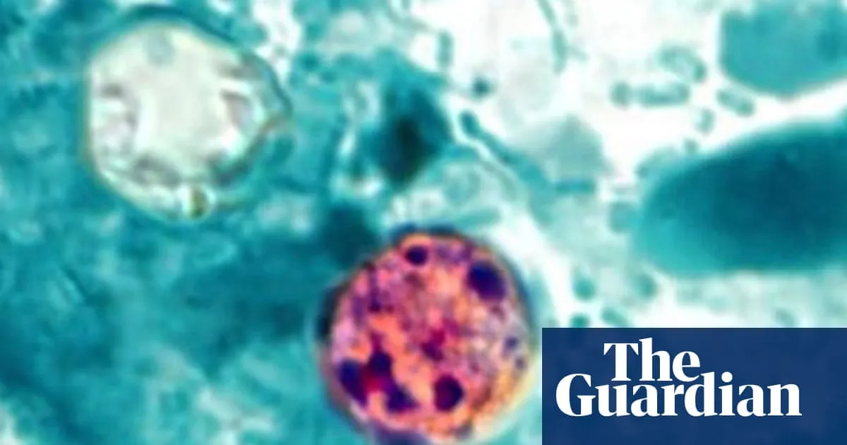 Multiple US states see alarming increase in cases of parasitic illness that causes ‘explosive’ diarrhea