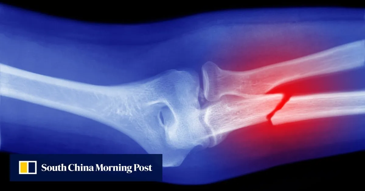 University to roll out screenings at pharmacies to uncover osteoporosis cases
