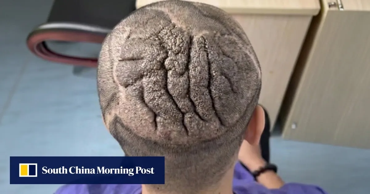 Rare medical condition causes Chinese man’s scalp to thicken and fold, resembling human brain